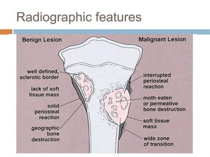 Are benign bone tumors painful