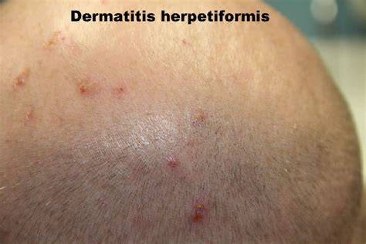 Can dermatitis herpetiformis appear on the face