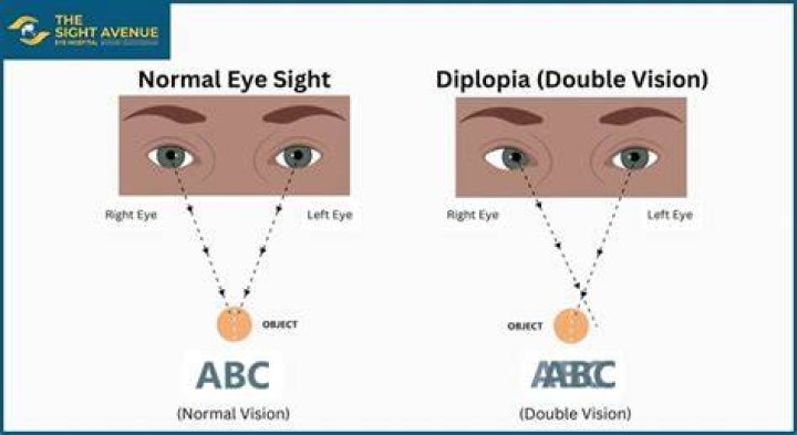 Can diplopia be corrected