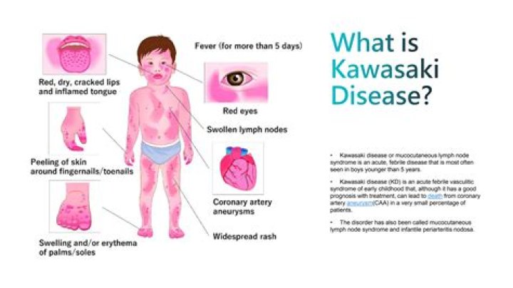 Can Kawasaki disease cause seizures