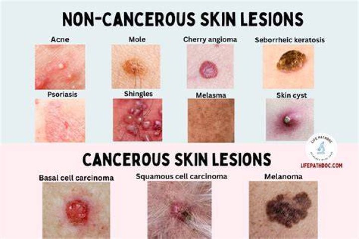 Can lesions be cancerous
