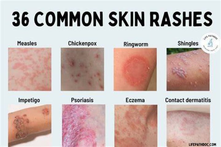 Can mass hysteria cause a rash