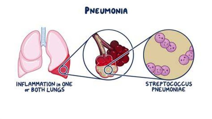 Can you get pneumonia from rats