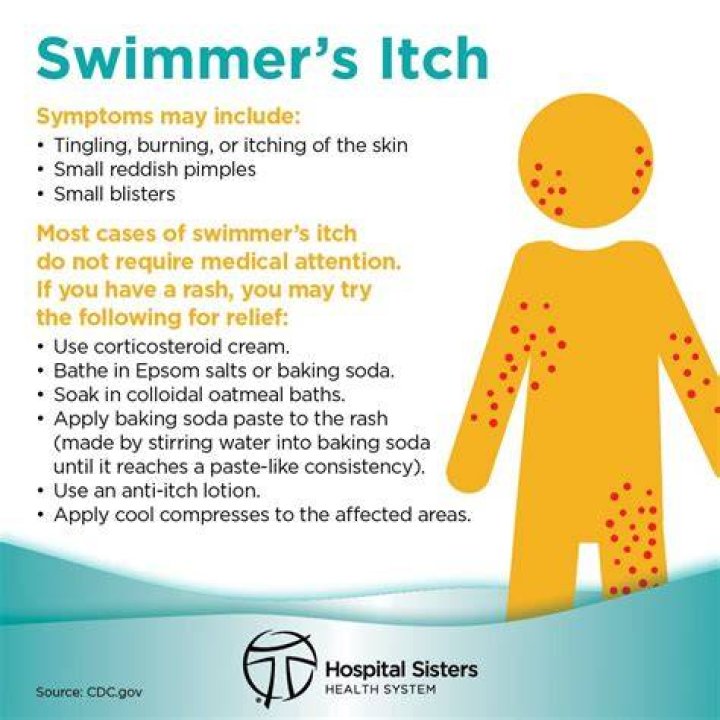 Can you get swimmers itch from a pool