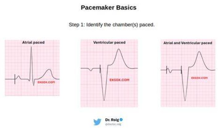 Can you have an EKG with a pacemaker