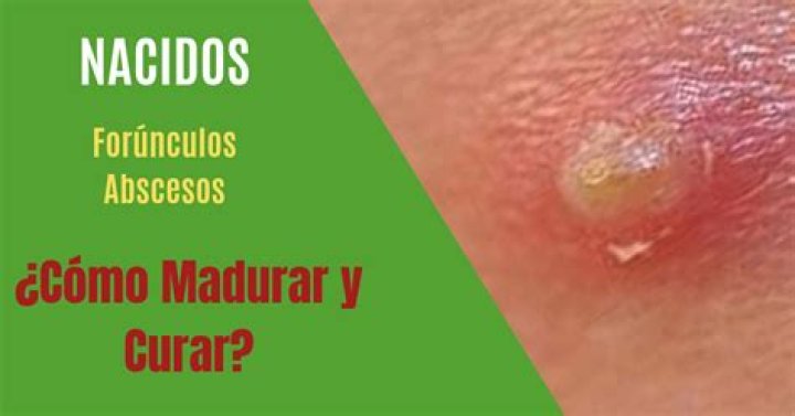 ¿Cómo se transmite el Forunculo