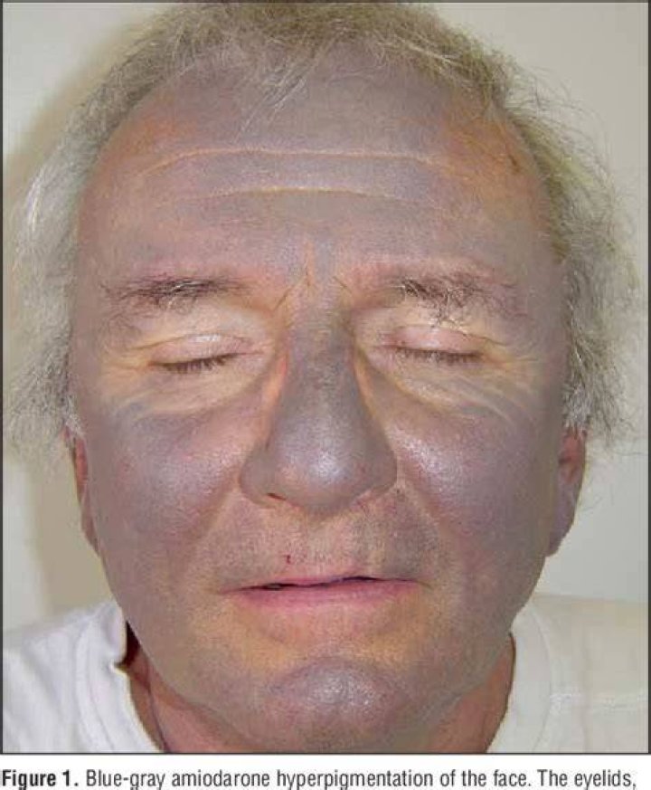Does amiodarone cause photosensitivity