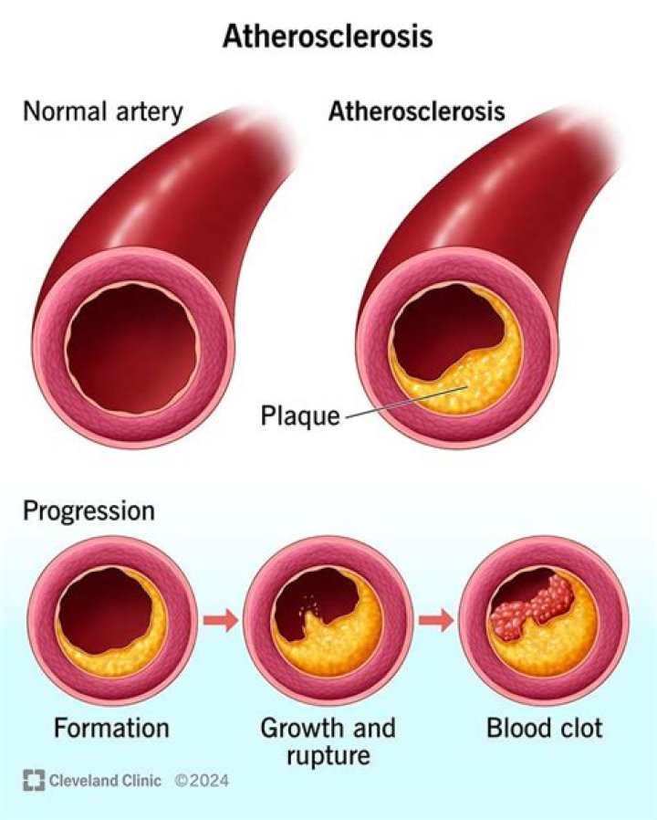 Does atherosclerosis cause low blood pressure