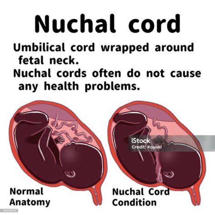 Does tight nuchal cord mean compression