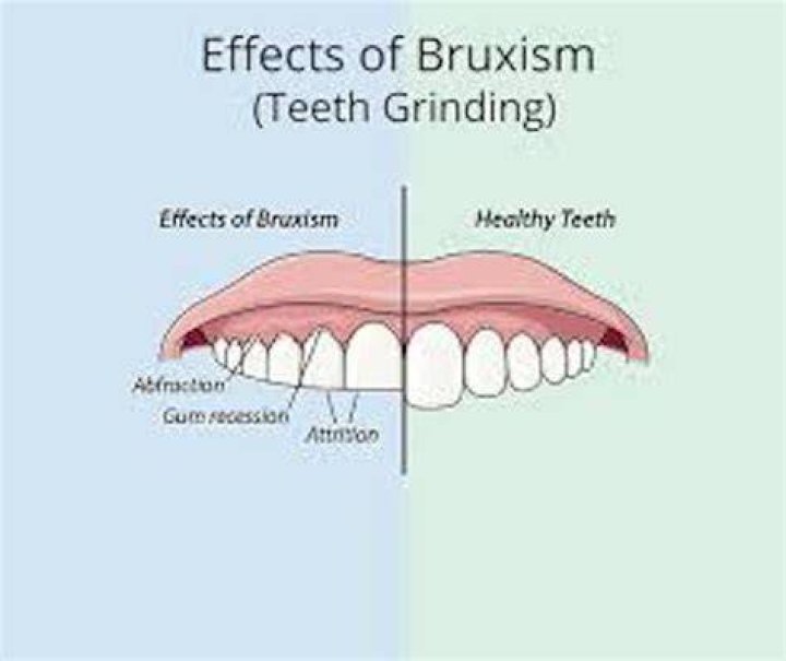 Does venlafaxine cause bruxism