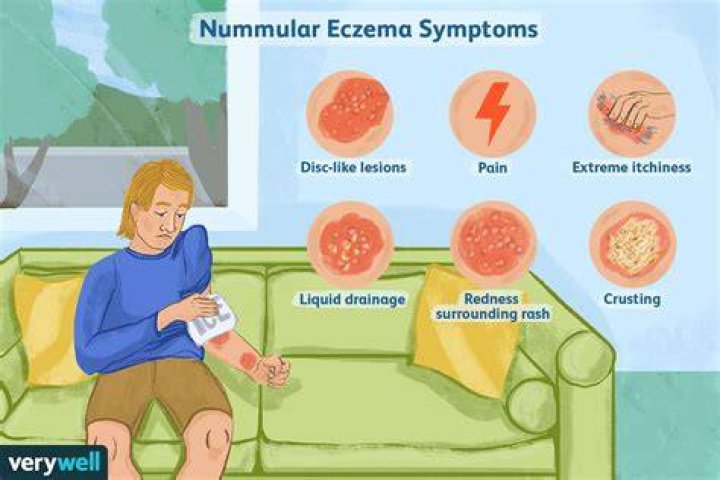 How can I prevent Nummular eczema