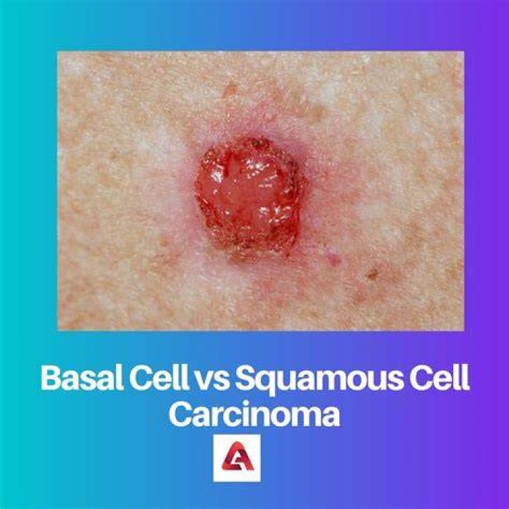How can you tell the difference between squamous cell carcinoma and basal cell carcinoma
