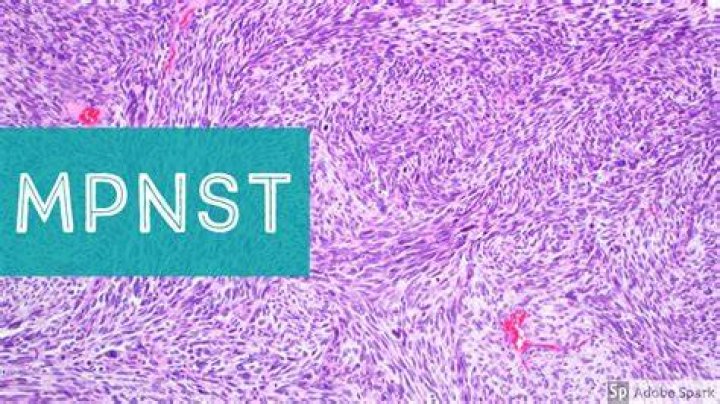How common is Mpnst