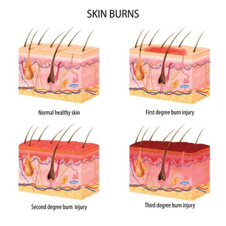 How do I know what degree burn I have