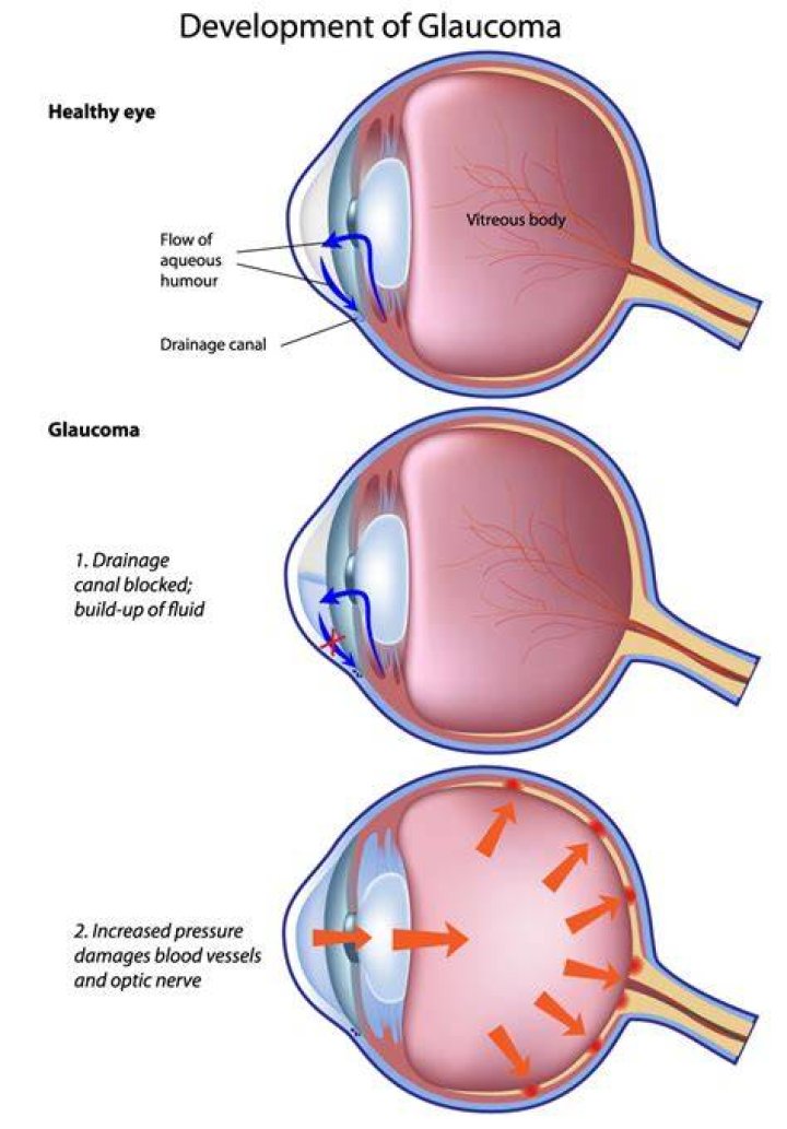 How do Miotics help glaucoma