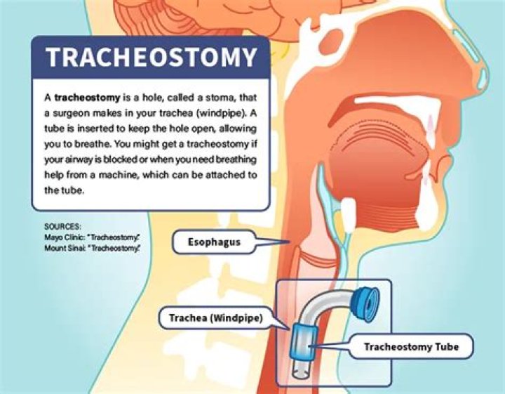 How do you confirm a tracheostomy placement