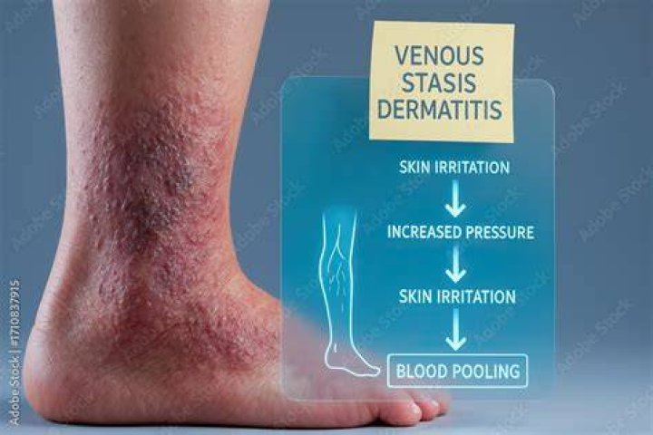 How do you cure stasis dermatitis