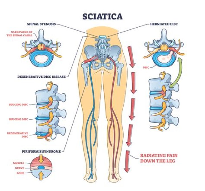 How do you spell sciatic pain