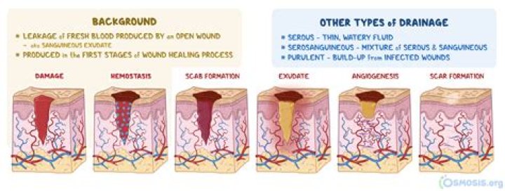 How do you stop a wound from oozing