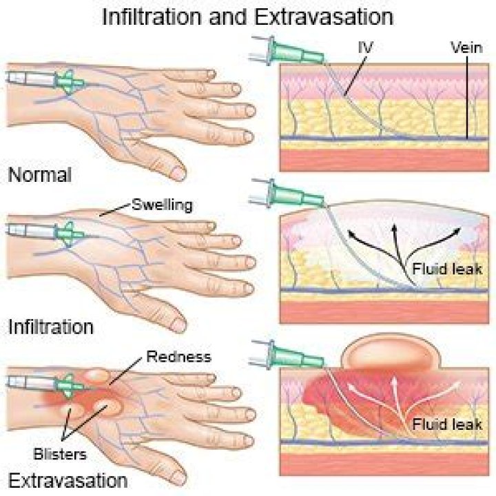 How do you test for IV infiltration