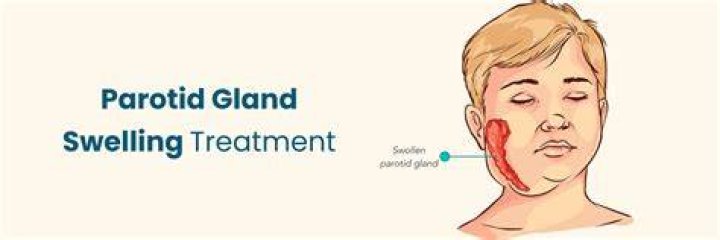 How do you treat parotitis at home