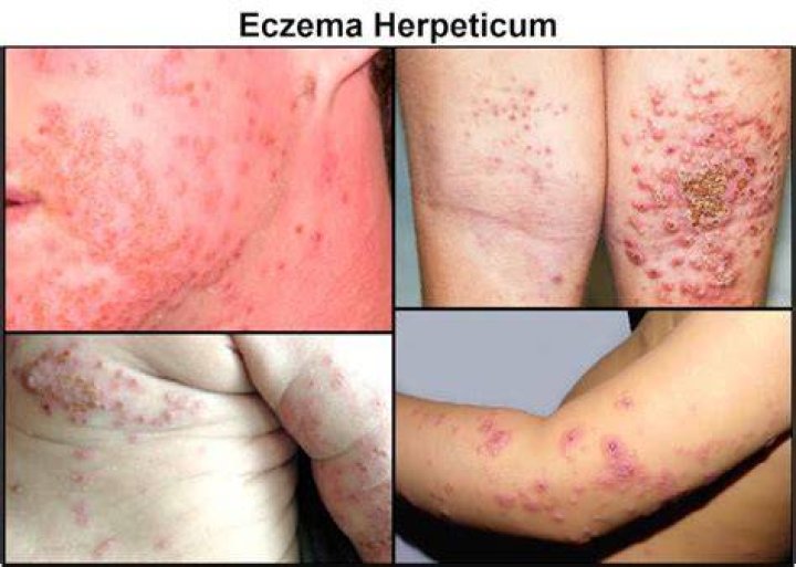 How does eczema Herpeticum start