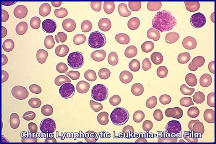 How is chronic lymphocytic leukemia diagnosed
