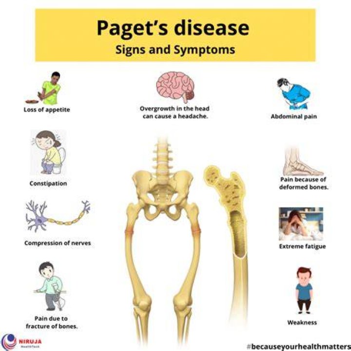 How is Pagets disease prevented