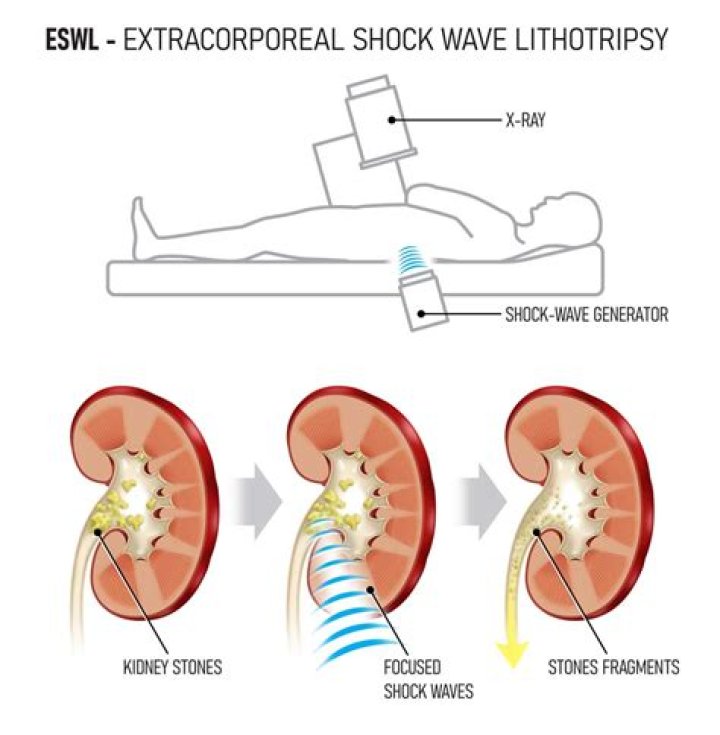 How lithotripsy is done
