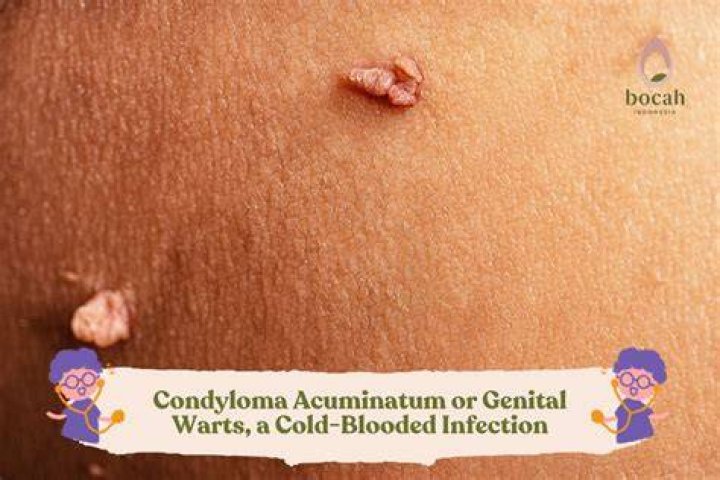 How long after genital warts am I contagious