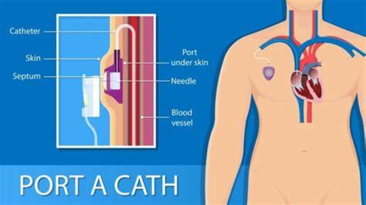 How long can port a cath stay in