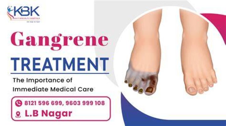 How long can you live with gangrene