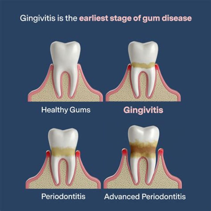 How long can you live with gingivitis