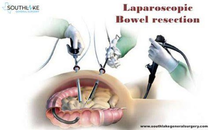 How long does it take to recover from a bowel resection