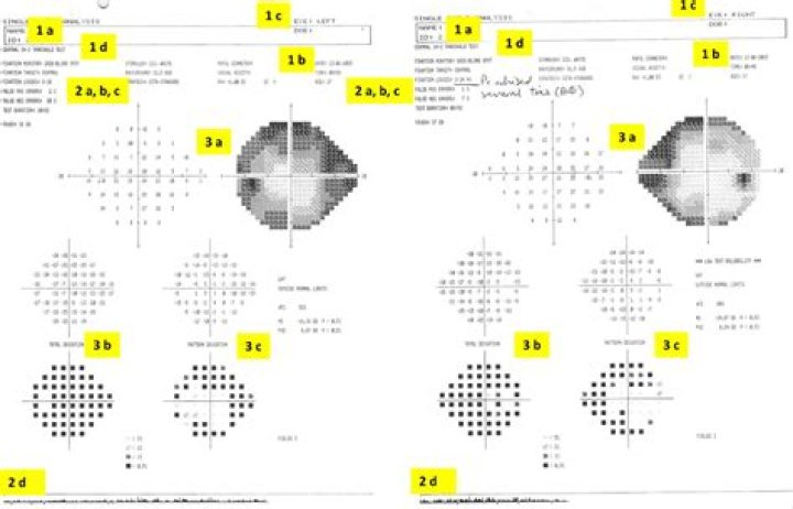 How visual field test is done