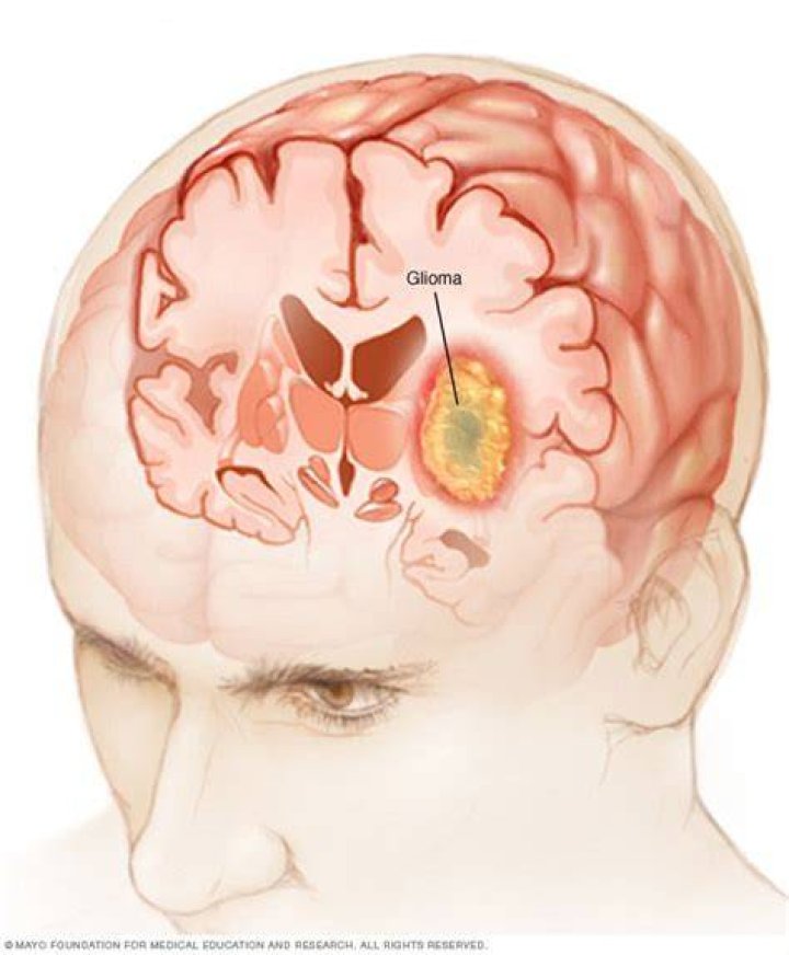 Is a glioma tumor cancer