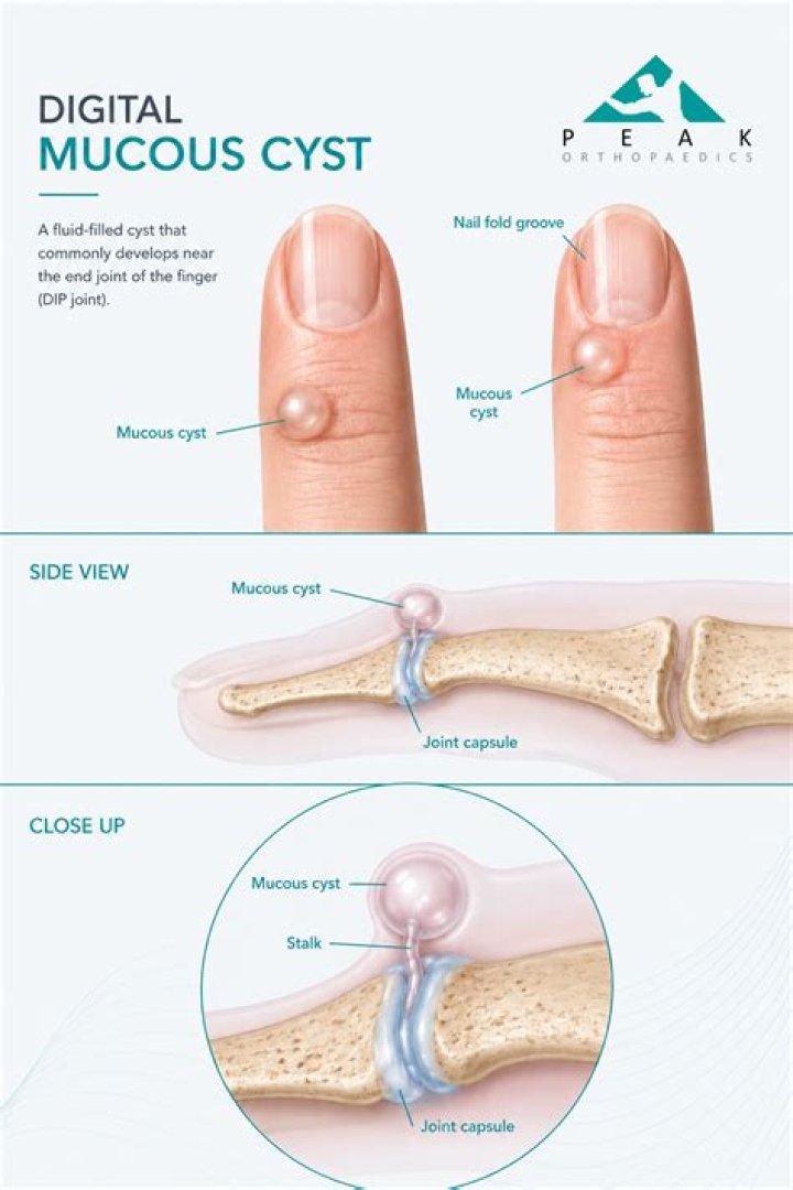 Is a mucous cyst the same as a ganglion cyst