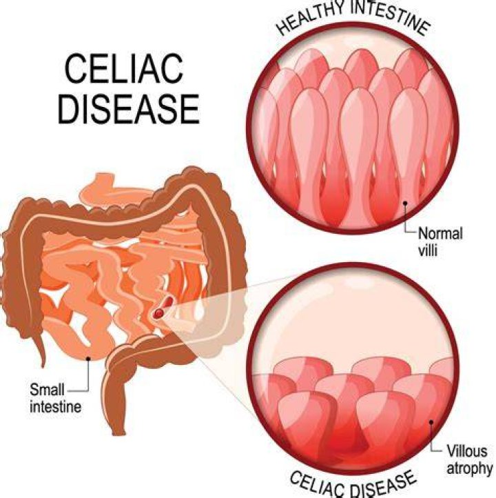 Is it celiac or celiac