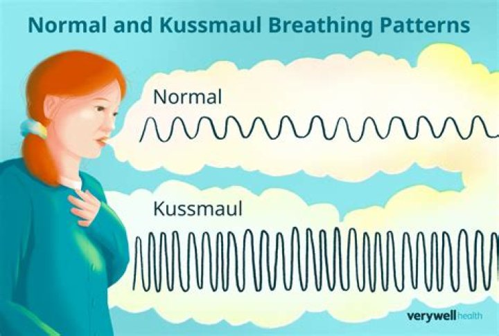 Is Kussmaul breathing hyperventilation