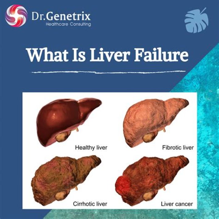 Is liver failure bad