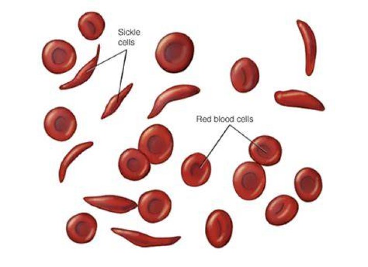 Is there any other name for sickle cell anemia
