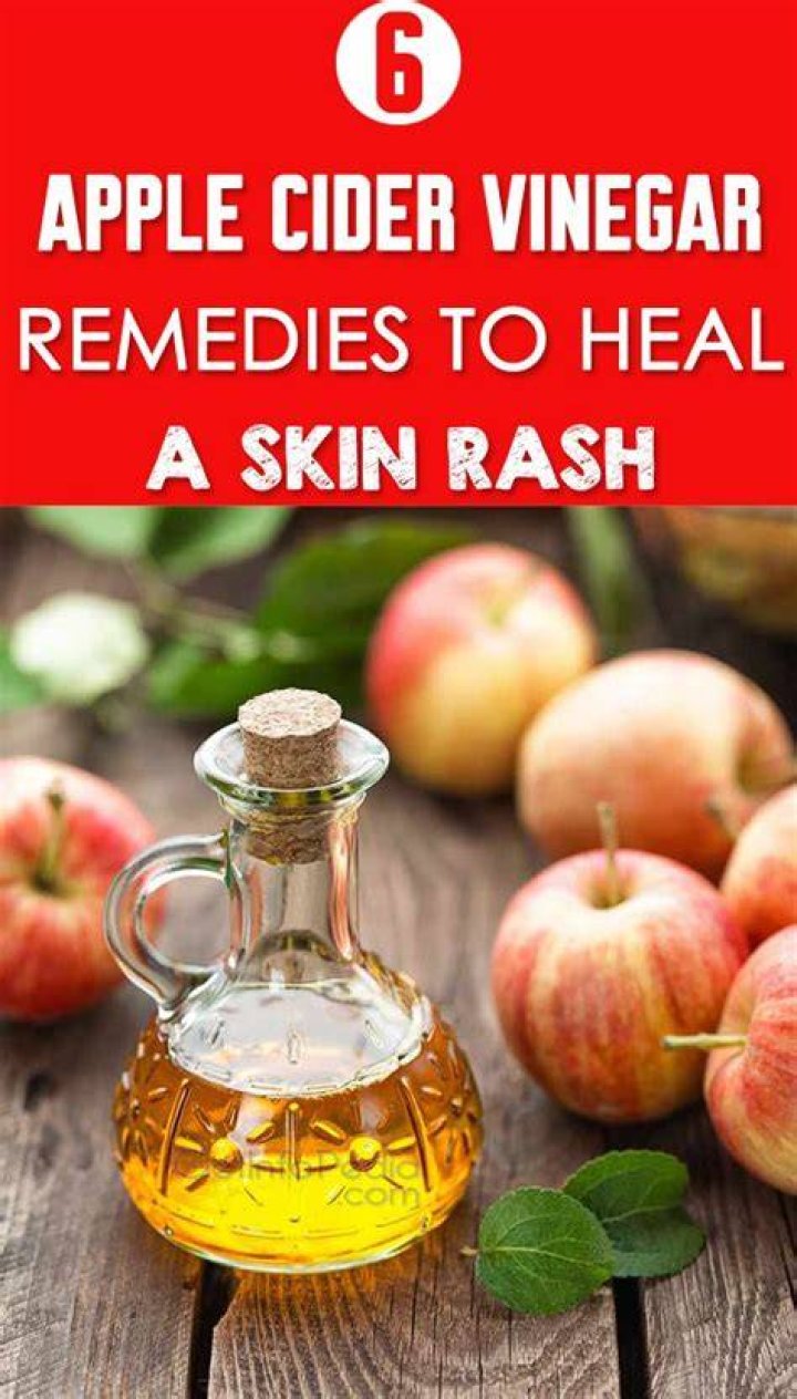 Is vinegar good for rashes
