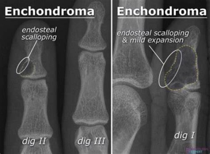 Should an osteochondroma be removed
