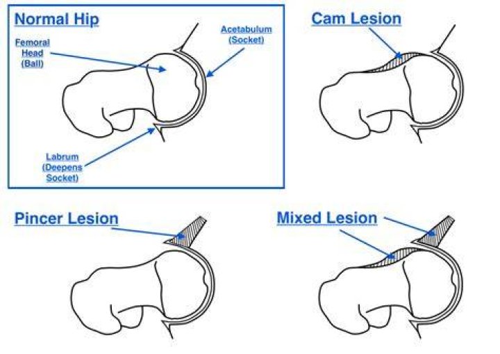 What are CAM lesions