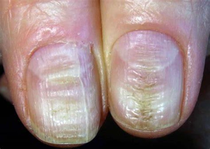 What are dystrophic nails