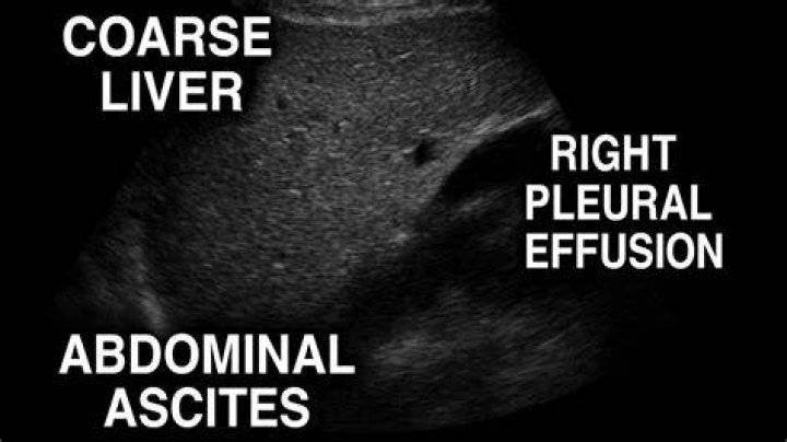What causes a coarse liver
