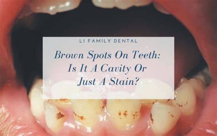 What causes brown spots on baby teeth