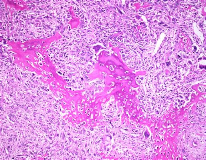 What causes Carcinosarcoma