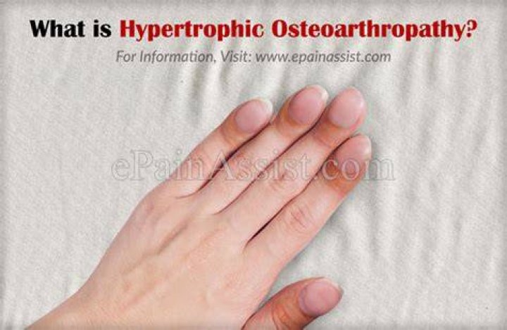 What causes hypertrophic osteoarthropathy