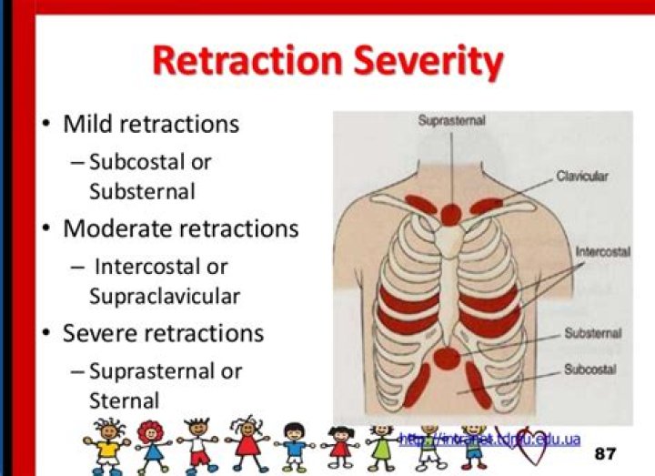 What causes intercostal recession